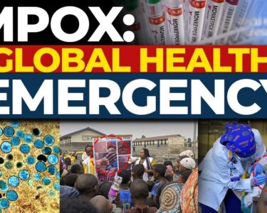 WHO Keeps Mpox as Global Emergengy – Cases on the Rise As a result, the World Health Organization (WHO) has classified the condition as mpox a public health emergency of international concern. We now look back to what fueled such a decision by grappling with the high number of increase in the number of cases and the widespread reach of the virus. Reasons as to why mpox remains in such high global stature The committee comprises of WHO officials as well as independent experts, and this time Whythe WHO Global Mpox Vaccine Boundary meeting was set in Geneva to specifically address the global mpox issues on the 20-21 November. The WHO’s committee joins together to meet and assist the cross barrier condition, which saw them approve the measure in consensus; With a few experts believing that a Degree of Emergency should be retained because: Increased number of cases since last records Traceable contact with the wider spread of the virus Geographical pockets which are making this strain hard to control Countries as well are not in sync which priority and aspects to tackle This Bind draws attention as to why countries are now gradually getting the mpox vaccine boundary in place and looking to tackle this preventing further outbreaks. Mpox: Reappearance in Modern Times: A Regional Perspective The mpox outbreak has consistently grazed the region during the revolutions of the past. The leading mpox cases have been from Congo as well as other regions in Africa in this particular decade. The recent outbreak in Aug 2022 caused concern among the health officials regarding any further recessions of the epidemic. Experts have even warned of a situation where the epidemic could be worse than that of covid-19. Effects in the Affected Countries and areas As seen in the DRC, it was noted that seats in places like Africa had the worst impact of mpox with profound violence. A few hundred deaths have surfaced which places evident pressure on the European Union as well as international aid in order to avoid another similar episode in containment strategies. Pivotal Roll Out of Vaccines and Issues in Distribution Due to there being a rising threat of misbehavior across the region, there was a need to roll out the first batch of vaccines and that was done last month and the goal did in fact seem to be accomplished as early evidence suggests otherwise but it is starting evidence. The WHO has sayed that there is more need to be done and more evidence means more assurance. In these regions it is ensured that there is an intent to possess resiliente settings, but it is still a major challenge to make items of desired access available equally. Explaining the Nature of Mpox: Causes and Effects A rare but noteworthy trait of the Mpox is its ability to become fatal, albeit severe. The Mpox virus is largely acquired by close interactions with infected individuals which include the following: Sweating together or even the slightest of contact between their skins Any form of sexual intercourse One’s lungs absorbing any infectious droplets from the air Once the virus finds its way into the human’s body, it begins replicating and targeting lymph nodes within the body which eventually leads to some inflammation. Swelling of the lymphatic system is common and the body develops rashes or lesions around that area. The Urgent Appeal for A Global Response The crisis caused by mpox can definitely be dealt with through the following strategies: Reforming the existing reporting and analyzing systems Ensuring adequate distribution of antiviral measures and vaccines Making the general public aware of precautions Providing Affected Areas With More Facilities And Support The Concluding Points Mpox is particularly a serious disease in Africa and needs to be addressed as a global threat. The global pandemic has created urgency with the WHO recently deciding to keep hui on a level one alert, and this alone is a signal that there is more to be done on a global scale that can go towards the prevention. An emphasis on vaccination, education by reallocating means and resources globally can help prevent future issues related to this illness.